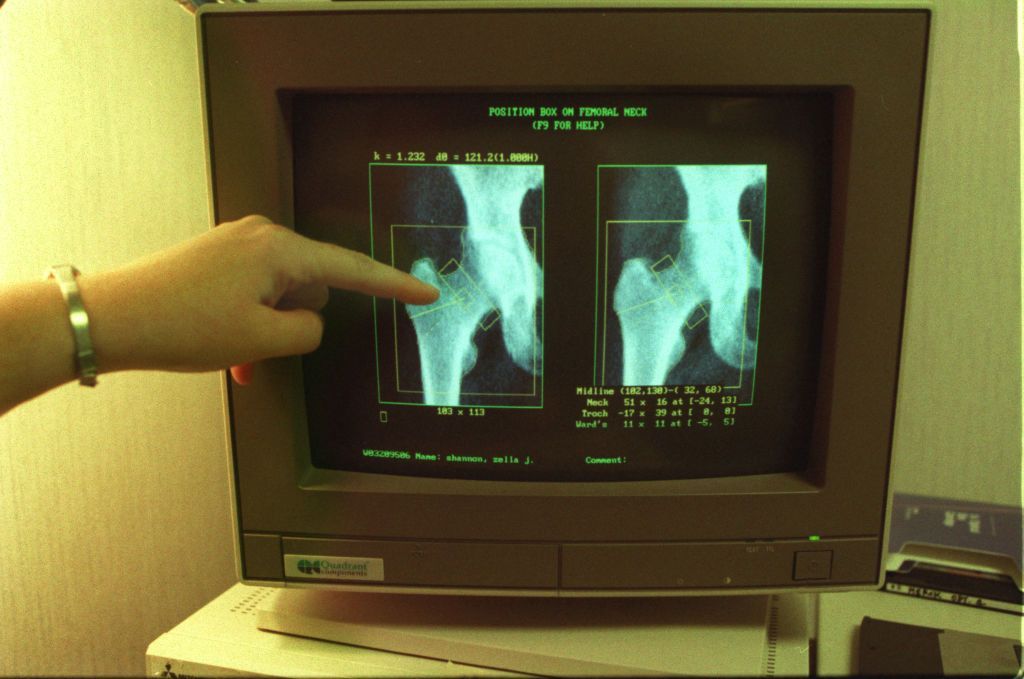 Zella Shannon, a volunteer in the osteoporosis study of women past 65 yrs. of age. lies still as a study co ordinator reads a base line scan that was done about 1990 and compares it with the newest scan to determne differences.(Photo By STORMI GREENER/Star Tribune via Getty Images)